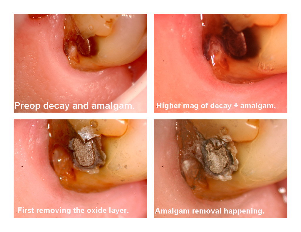 Amalgam removal pg 1.jpg